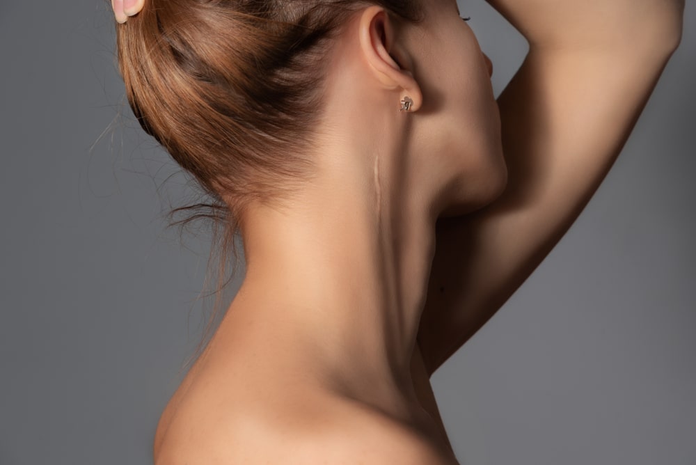 Woman with surgery scar at her neck.