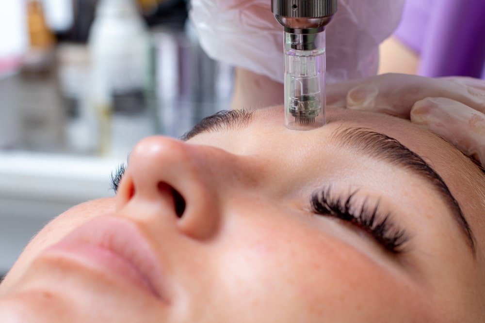 Microneedling in Frisco, Texas